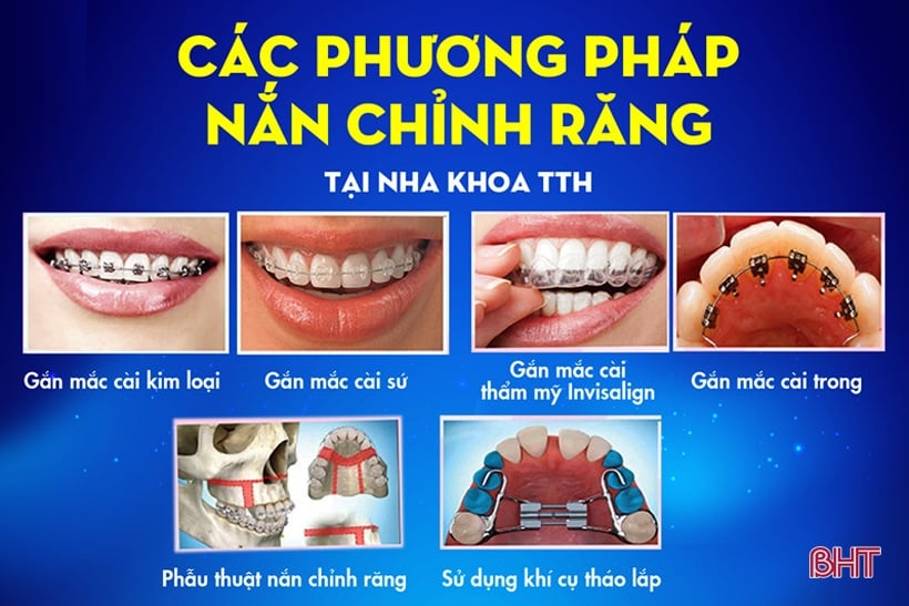 โรงพยาบาล TTH Ha Tinh General มอบแรงจูงใจและการสนับสนุนที่ยอดเยี่ยมสำหรับบริการทันตกรรมจัดฟัน