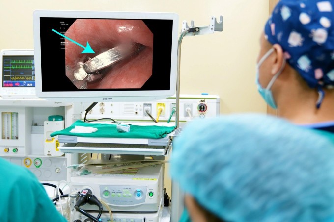 Gastroenterologist uses endoscopy to remove foreign object in patient's esophagus. Photo: Provided by hospital