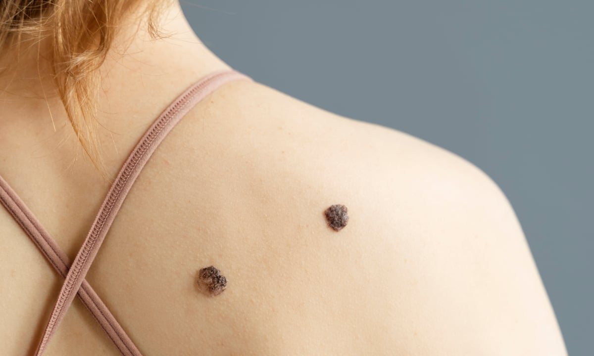 Test which moles warn of disease