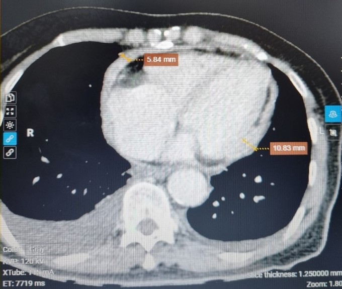 Imagen de pericardio engrosado, cuya parte más gruesa alcanza hasta 11 mm, en la resonancia magnética cardíaca. Foto: Hospital Tam Anh