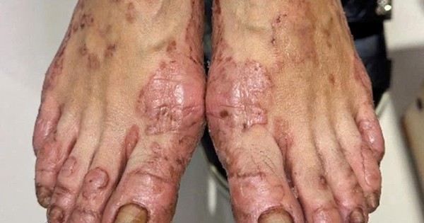 Éruption cutanée, démangeaisons et suintements des mains et des pieds dus à une dermatite atopique