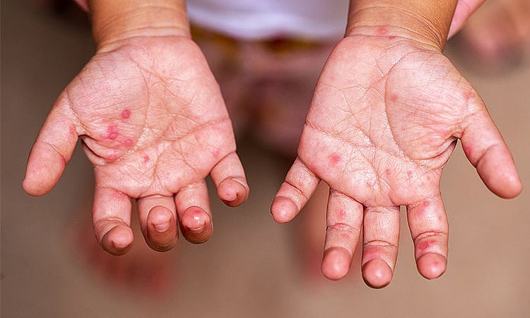 3 signes dangereux de la maladie pieds-mains-bouche