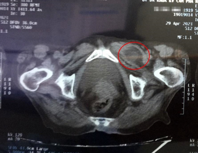 Bild einer Obturatorhernie auf der Computertomographie. Foto von : Hospital provided