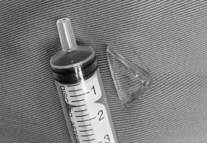Glassplitter aus dem Knie eines Jungen entfernt. Foto von : Hospital provided