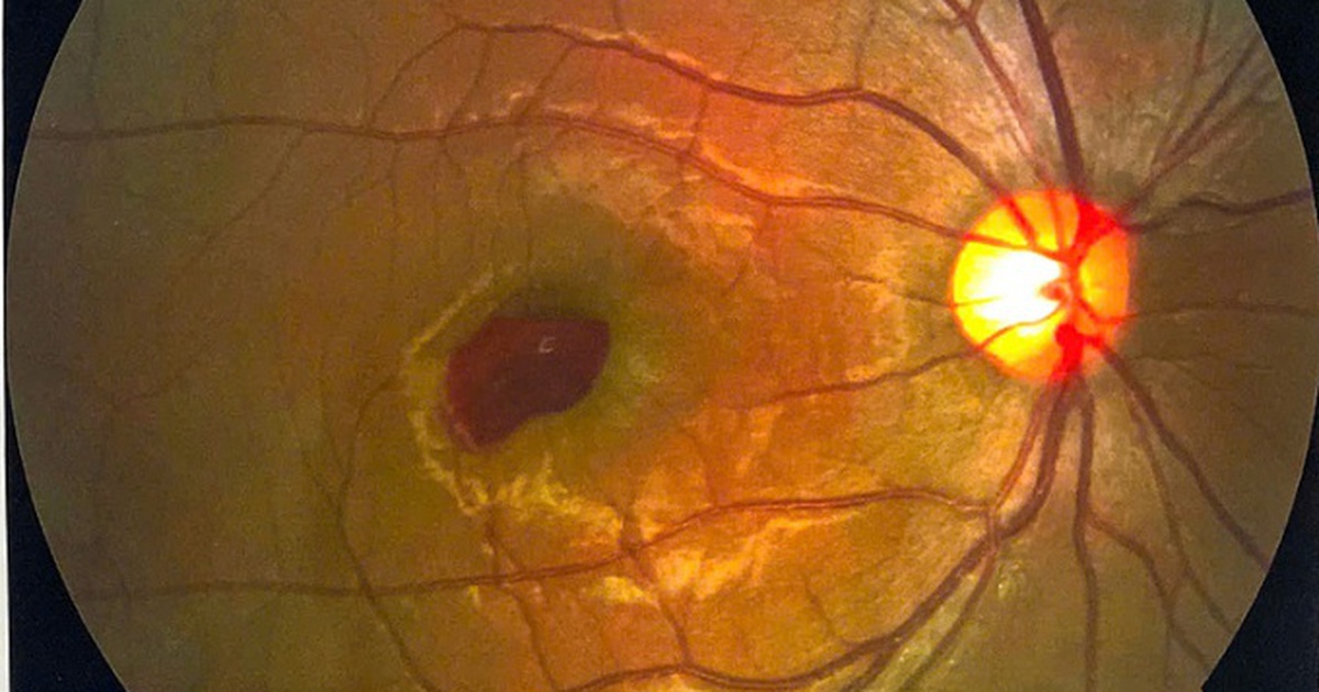 Why can laser light shining into the eye cause blindness?