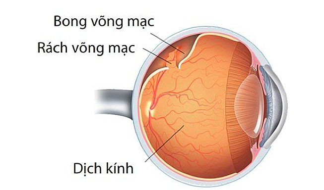 Blind in one eye after one month of retinal detachment