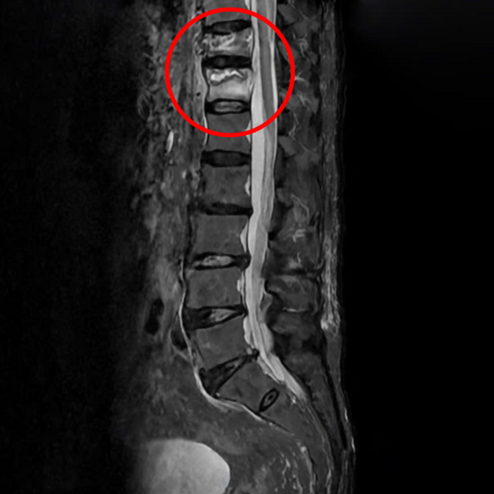 Resultados de la radiografía de las vértebras T11 y T12 rotas y colapsadas del hombre de 96 años.
