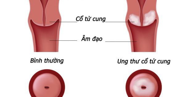 건강보험기금에서 보장하는 비용 목록에 암 검진을 포함시키는 제안