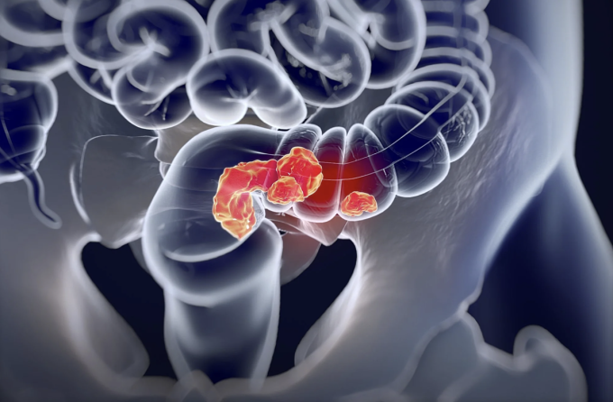 Illustration eines Dickdarmkrebstumors. Foto: Anatomy Image