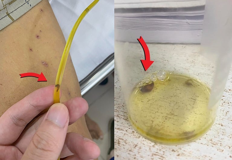 Hiếm gặp, sán lá gan chui ra từ ống dẫn lưu đường mật - Ảnh 3.