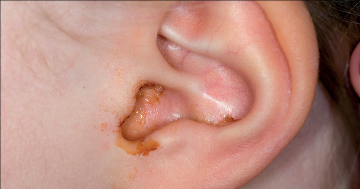 Is acute otitis media dangerous for children?