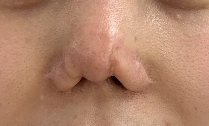 Deformed nose area after 10 repairs. Photo: Provided by doctor