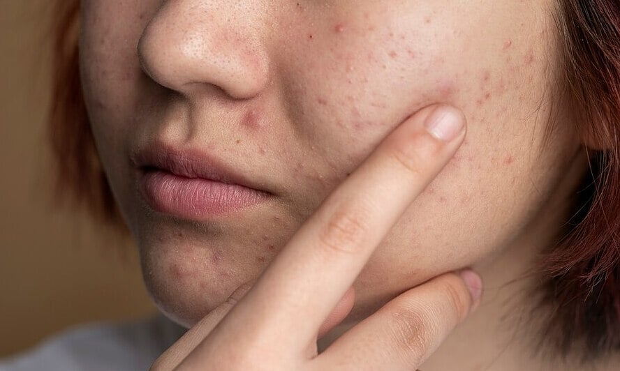 Schädliche Auswirkungen von Microneedling zur Aknebehandlung