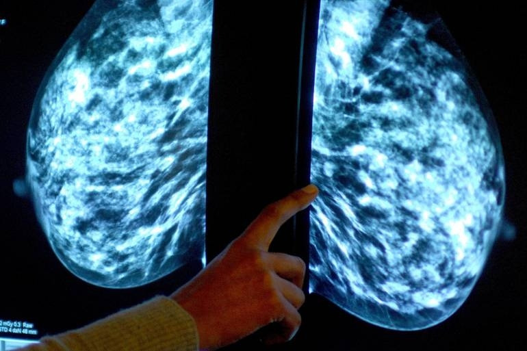 Développement d'un dispositif d'IA pour prédire la survie des patients atteints de cancer