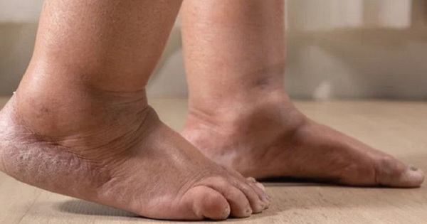 3 signes accompagnés d'un gonflement des jambes qui nécessitent une visite hospitalière immédiate