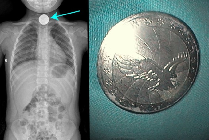 Image of foreign object at the beginning of the esophagus on X-ray (left) and after it has been removed (right). Photo: BVCC