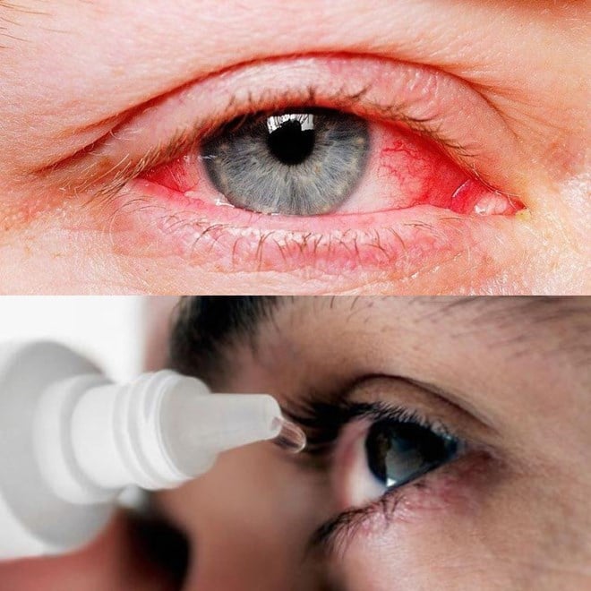5 infecciones oculares comunes que debes conocer