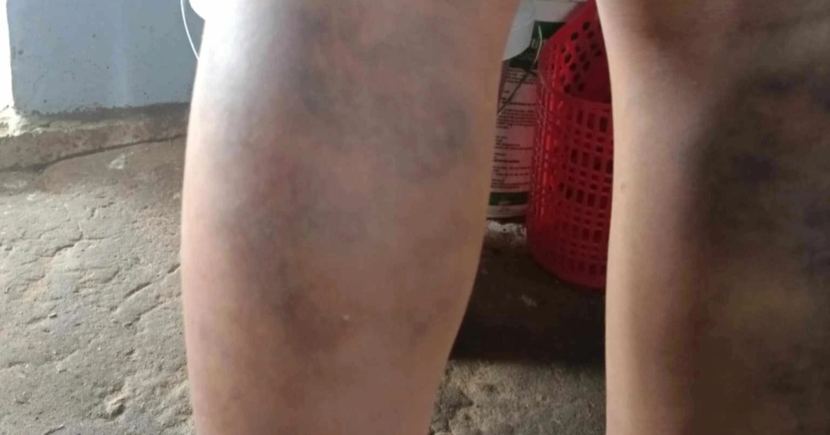 Suspend homeroom teacher who beat student, causing bruising on both legs