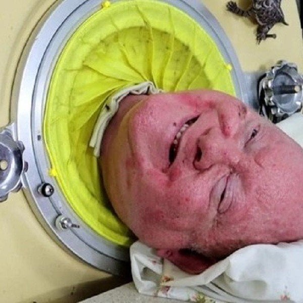 Man who breathed through an “iron lung” for over 70 years has just passed away