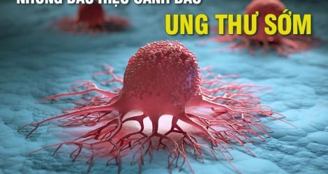 Những dấu hiệu cảnh báo ung thư sớm