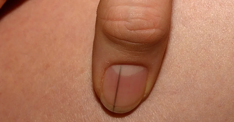 Black stripes on fingernails, is it skin cancer?