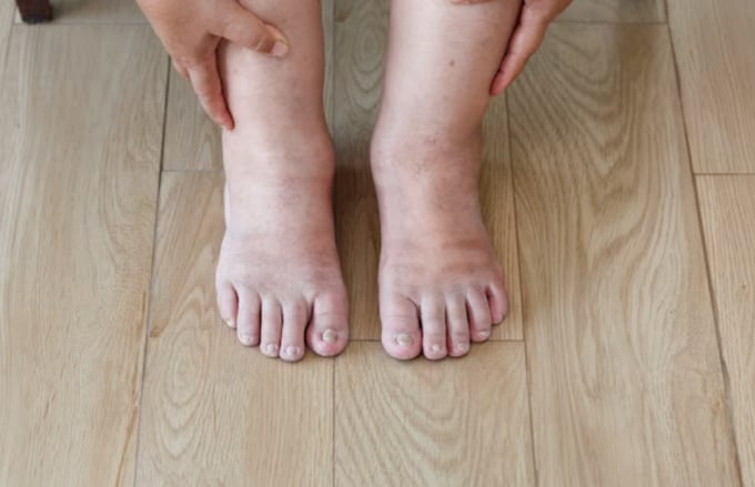 6 tips to reduce swelling of feet and ankles due to heat