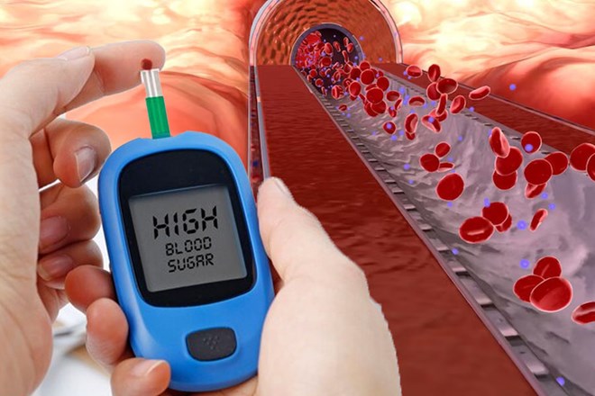 Los niveles altos de triglicéridos se asocian con un mayor riesgo de diabetes