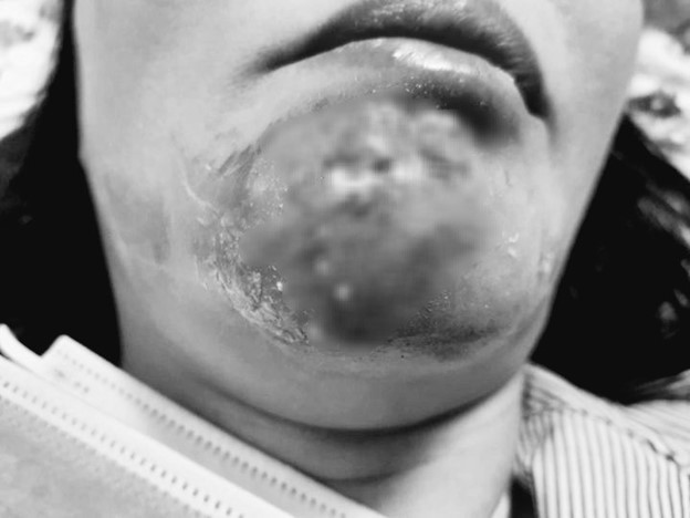 Photo 1 d'une femme souffrant d'acné et présentant une déformation du visage