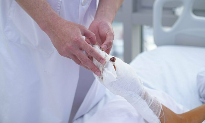 Blessure à la main causée par des pétards. Photo : Hôpital fourni