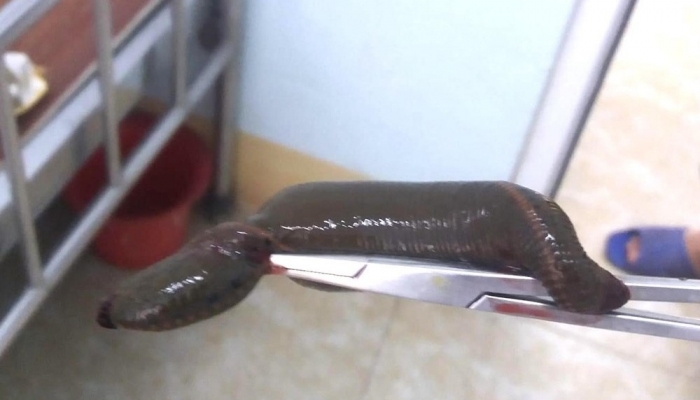 71-year-old man calls for doctor's help because leech crawled into his "private part"