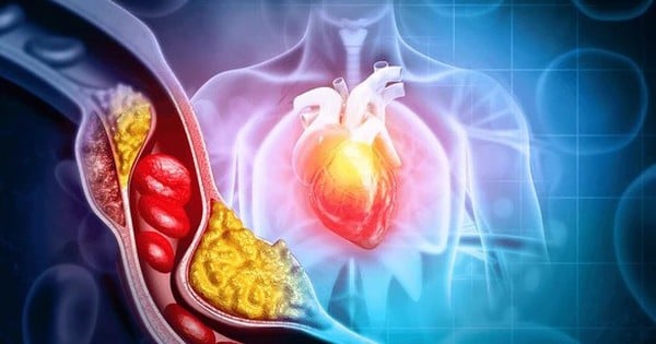 Dấu hiệu cholesterol cao đã chuyển thành bệnh nguy hiểm