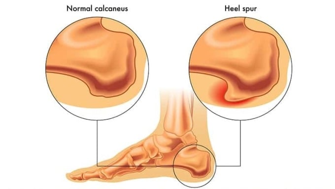 Vị trí xương gót chân (giữa - dưới), phần gót chân bình thường (phải - trên) và gót chân bị gai (trái - trên).