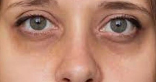 Dark circles under eyes, is it just due to lack of sleep?