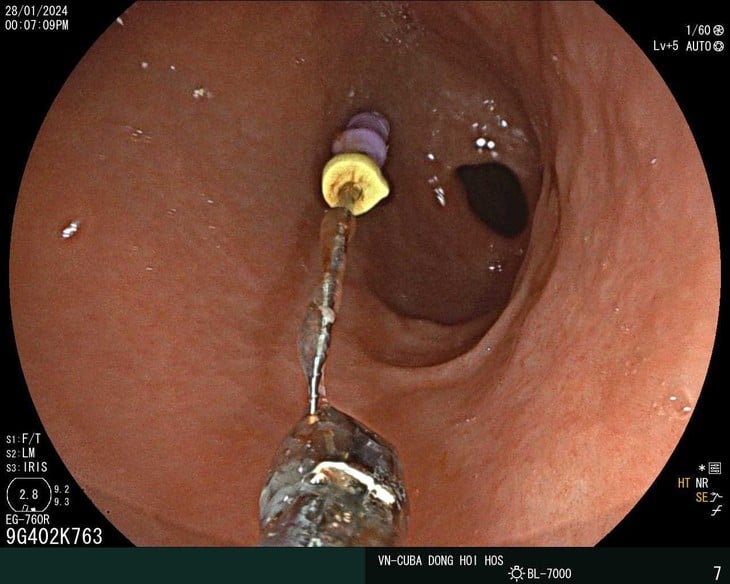 5세 소년이 복부에 25cm 길이의 치과용 바늘을 삼켜 병원에 입원 사진 1