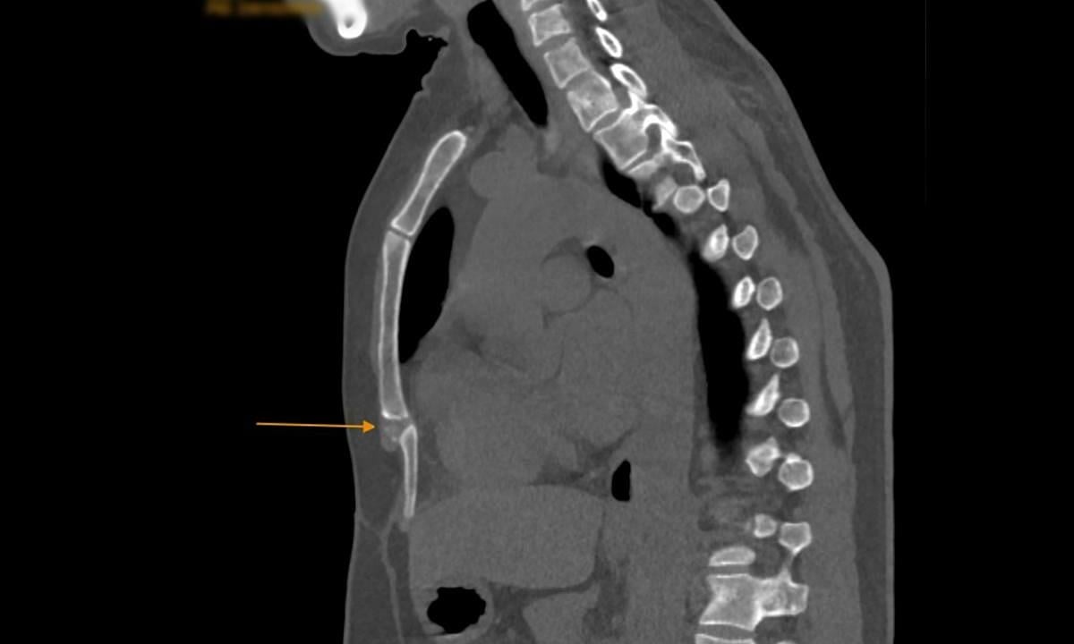 Stomach pain all year long before knowing about sternum damage