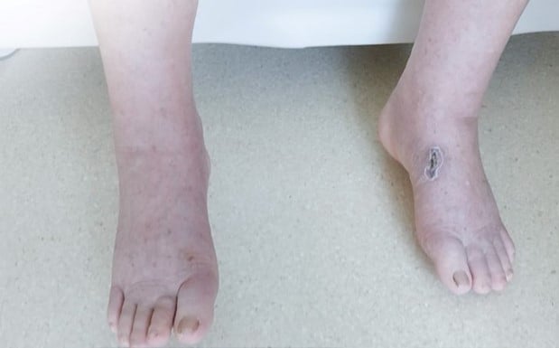 Swollen legs, shortness of breath due to using "imported" functional foods containing Corticoid