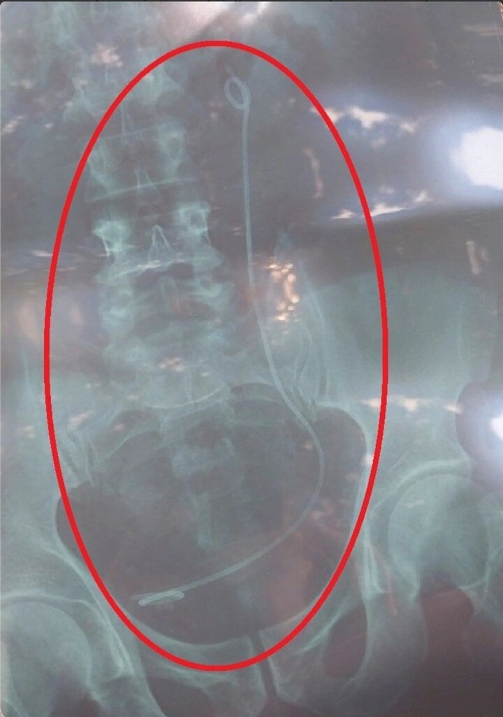 X-ray film showing a piece of wire in the abdomen was mistakenly returned to patient H.