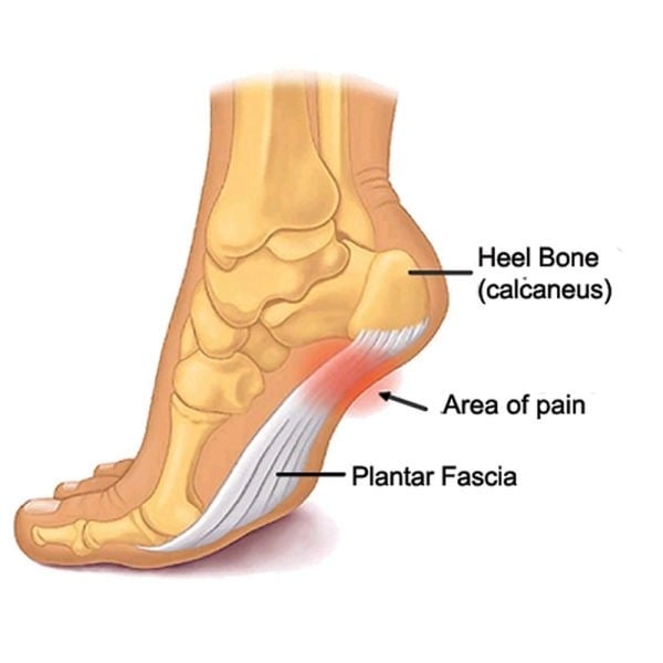 Vị trí bị đau (Area of pain) gần phần xương gót (Heel Bone) và nằm trên phần cân gan bàn chân (Plantar Fascia).