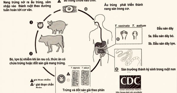 Bandwurmerkrankung durch den Verzehr von rohem Fleisch