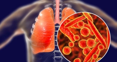 Tuberculosis symptoms are easily confused with digestive diseases.