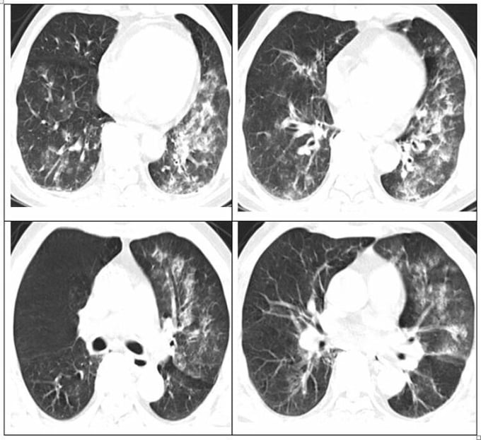 Hình ảnh phổi của người bệnh bị viêm lan tỏa và đông đặc. Ảnh: Bệnh viện cung cấp