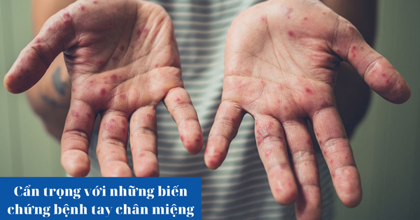 Cẩn trọng với những biến chứng tay chân miệng ở trẻ em!