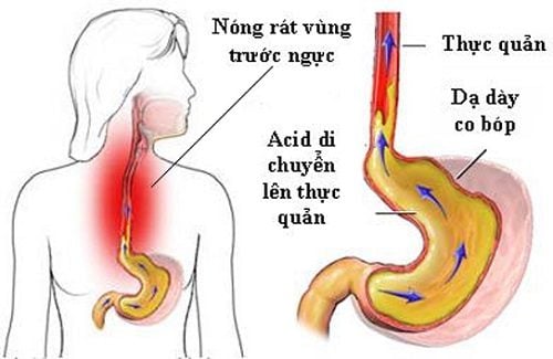 Người phụ nữ 30 tuổi bị loét hoàn toàn thực quản vì 1 sai lầm nhiều người Việt mắc phải khi uống thuốc - Ảnh 3.