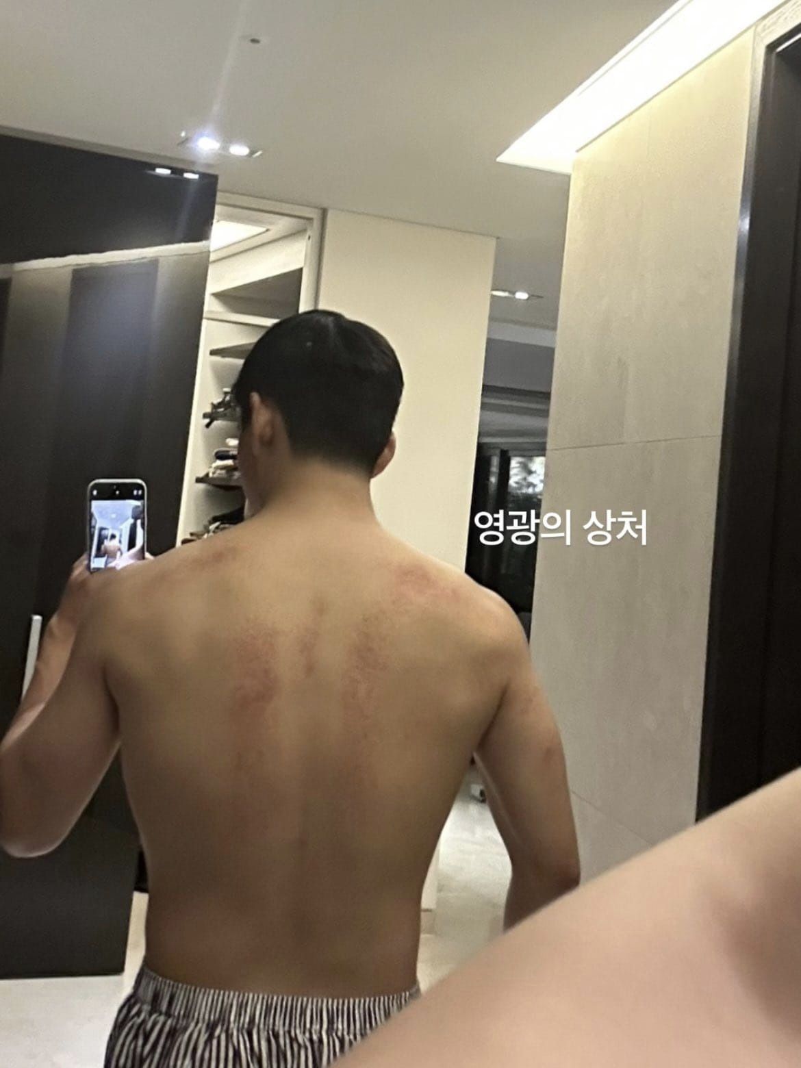 V reveals the wounds on his back. Photo: Instagram