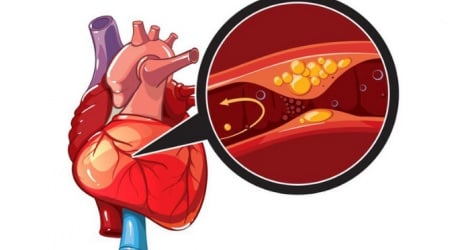 ជំងឺ myocardial infarction ស្រួចស្រាវដោយសារតែទម្លាប់នៃការជក់បារី និងការព្រមានពីអ្នកជំនាញ