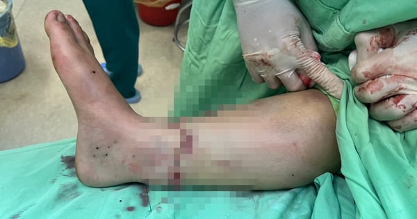 5-hour surgery to reattach severed foot for female patient