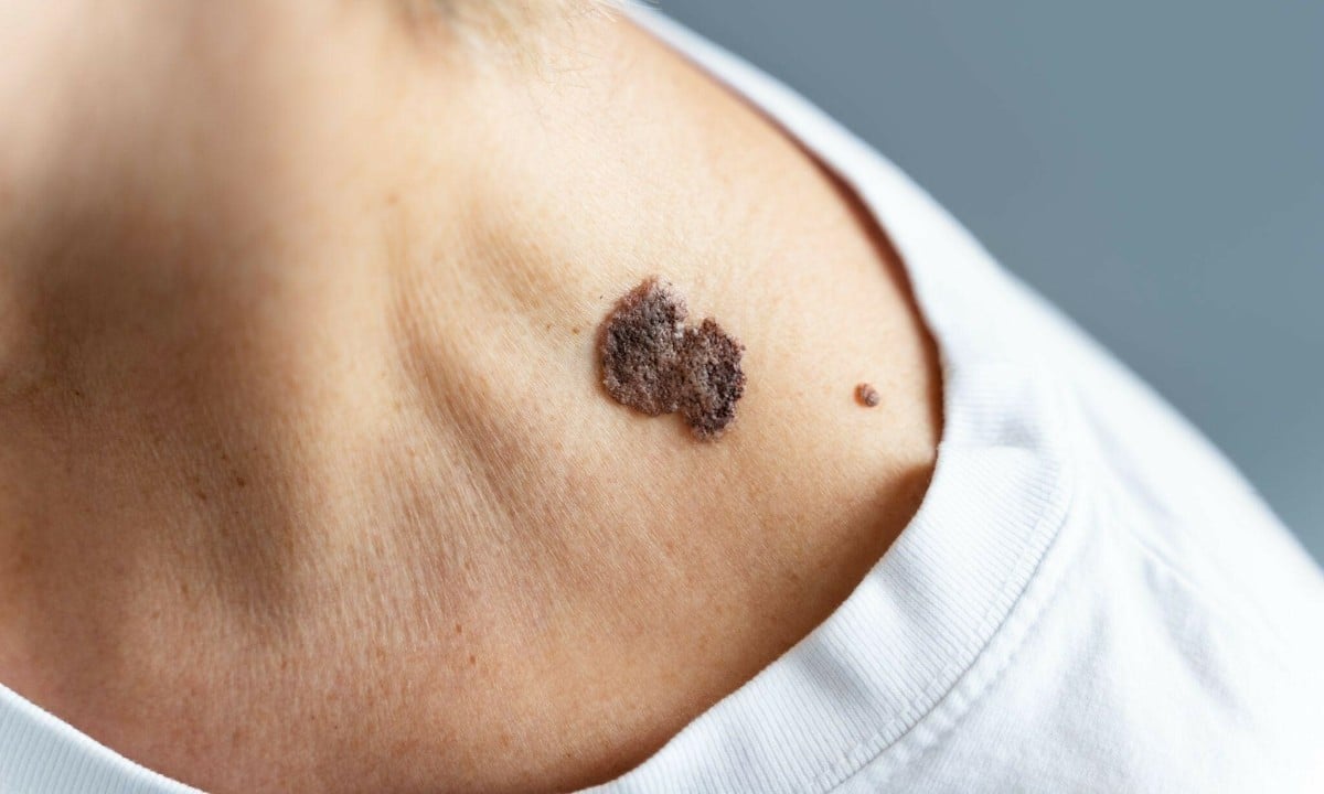 Skin signs warning of cancer