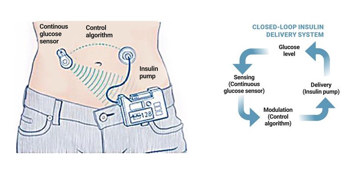 Tụy nhân tạo: Sản phẩm trí tuệ kết nối từ những người bệnh đái tháo đường ảnh 1