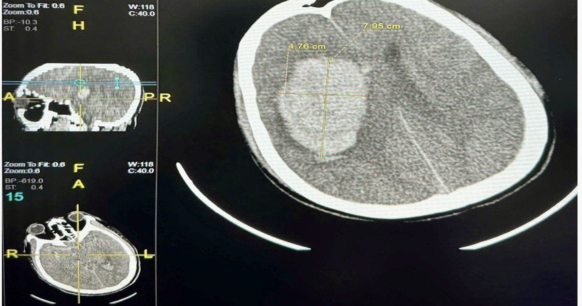 Consecutive cases of stroke after late night bath