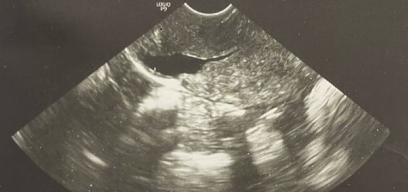 La imagen de ultrasonido muestra una cicatriz de cesárea antigua con líquido que mide 7,4 x 6,8 mm.